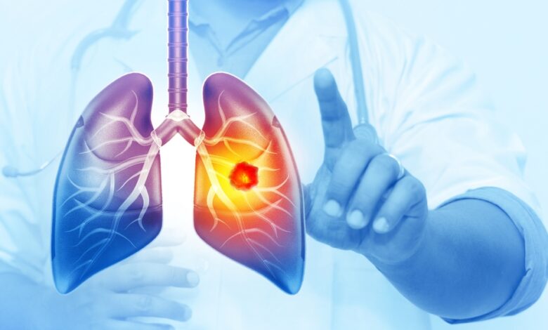 Her Yıl 25 Bin Akciğer Kanseri Vakası Önlenebilir